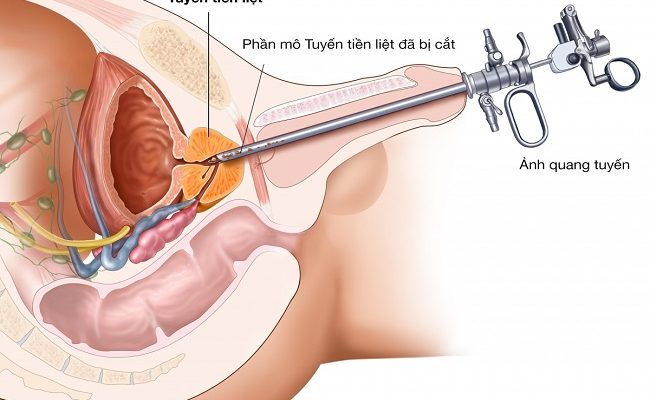 Mổ cắt tiền liệt tuyến qua niệu đạo